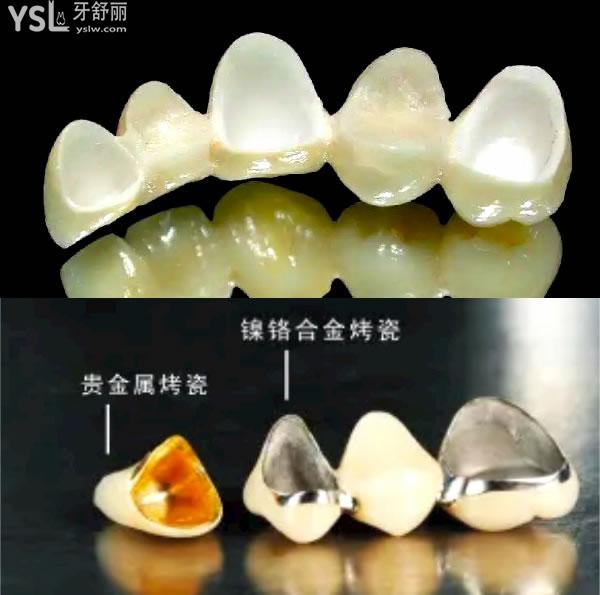 贵金属烤瓷牙(贵金属烤瓷牙图片)